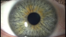 زراعة القرنية