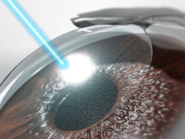 عمليات تصحيح عيوب الإبصار بالليزر