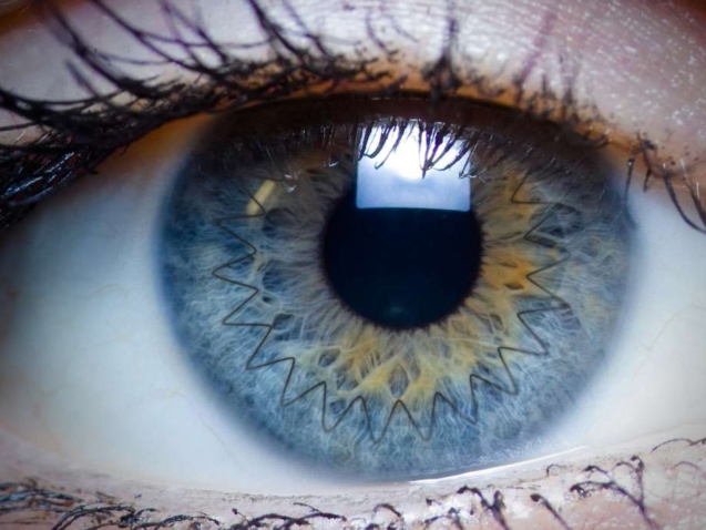 زراعة القرنية الأمامية العميقة DALK