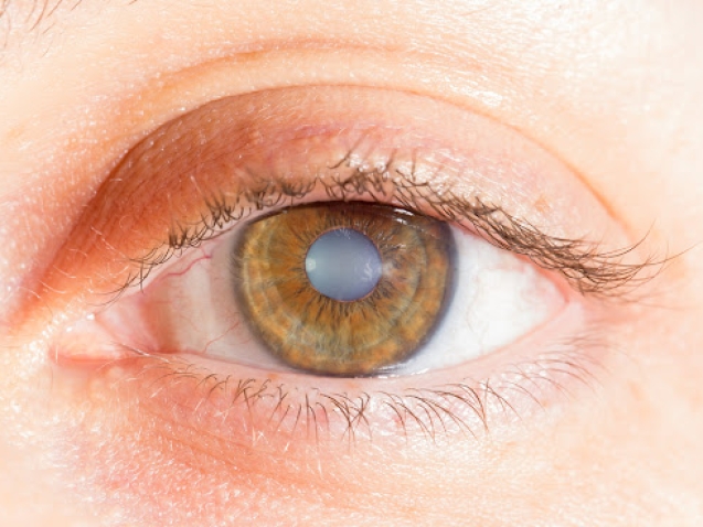 علاج المياه البيضاء