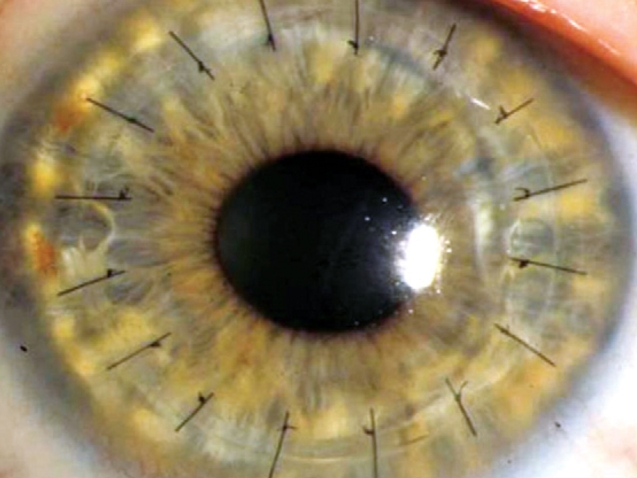 أنواع زراعة القرنية