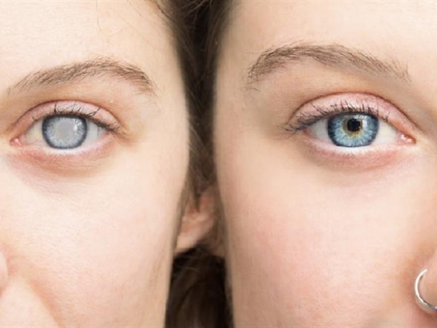 الفرق بين المياه البيضاء والمياه الزرقاء