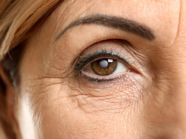 سعر عملية المياه البيضاء بالليزر