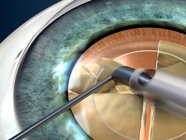 نسبة نجاح عملية المياه البيضاء