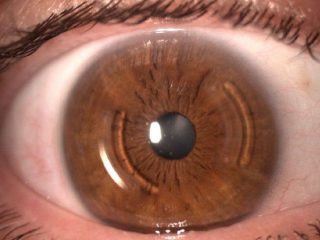 زراعة الحلقات لعلاج القرنية المخروطية