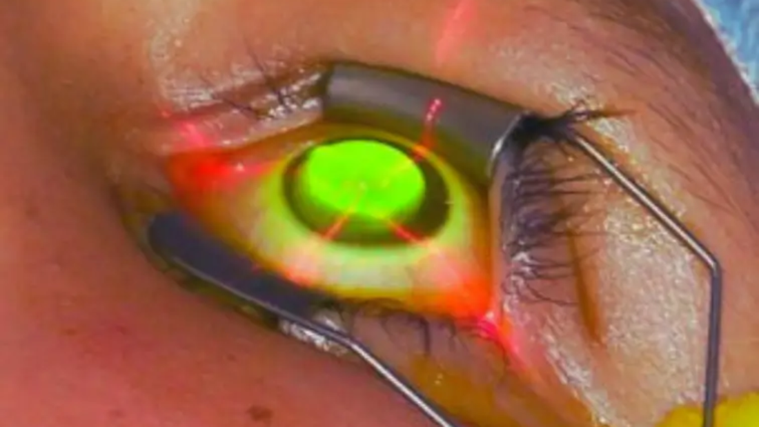 عملية تثبيت القرنية المخروطية بالريبوفلافين والأشعة فوق البنفسجية