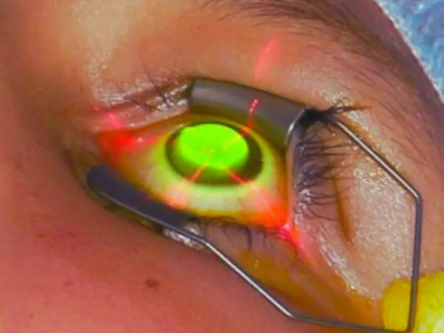 عملية تثبيت القرنية المخروطية بالريبوفلافين والأشعة فوق البنفسجية