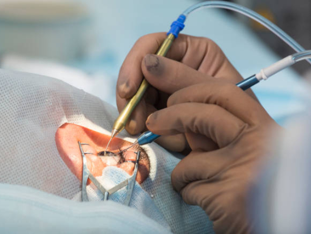 أنواع عدسات المياه البيضاء