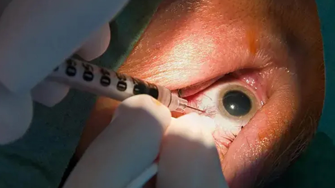 حقن العين لعلاج الارتشاح لدى مرضى السكري