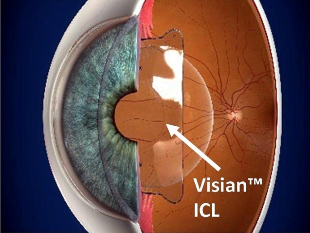 أنواع عدسات ICL في مصر